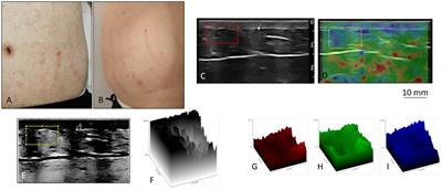 Stretch marks: a visible expression of connective’s involvement in autism spectrum disorders